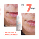Avene Cleanance Comedomed